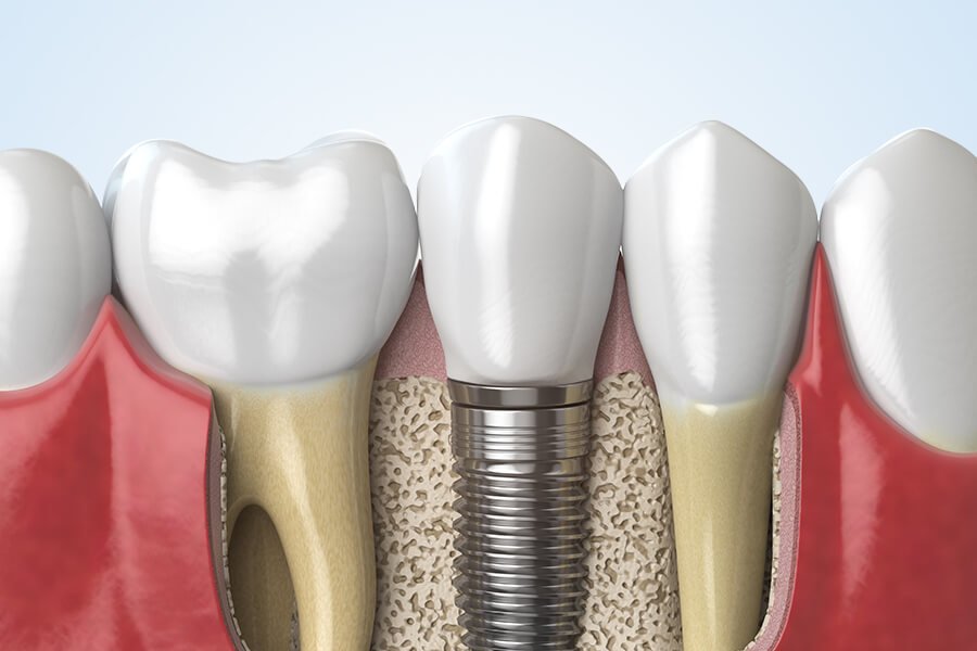All on Four Implant Cost in Turkey All on Four Implant Cost in Turkey