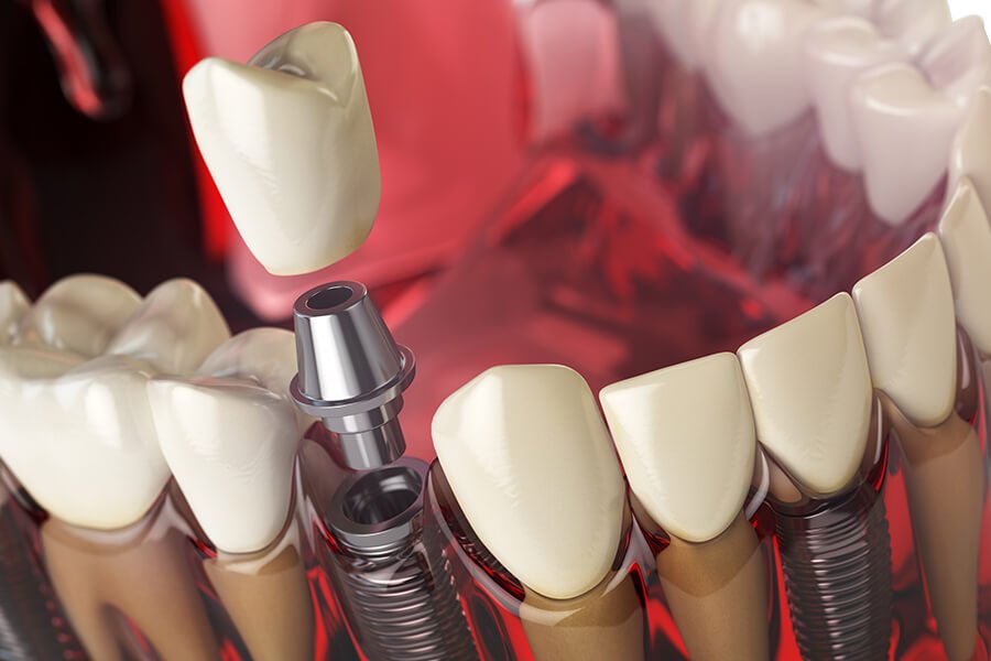 Dental Crown Cost in Turkey Dental Crown Cost in Turkey