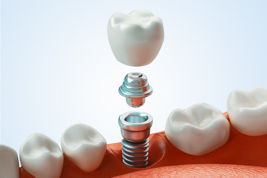 Dental Implant Cost in Turkey Dental Implant Cost in Turkey