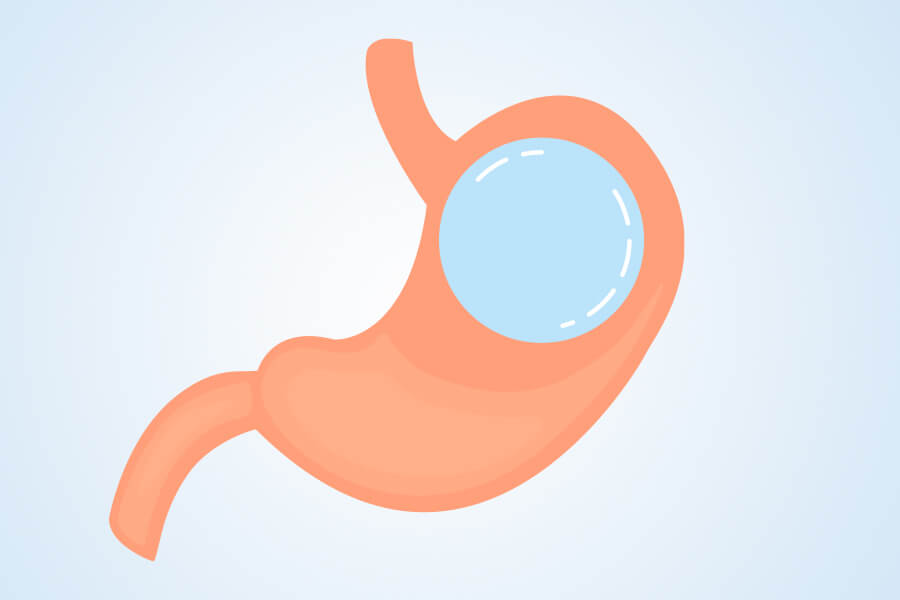 Gastric Sleeve in Turkey Gastric Sleeve in Turkey