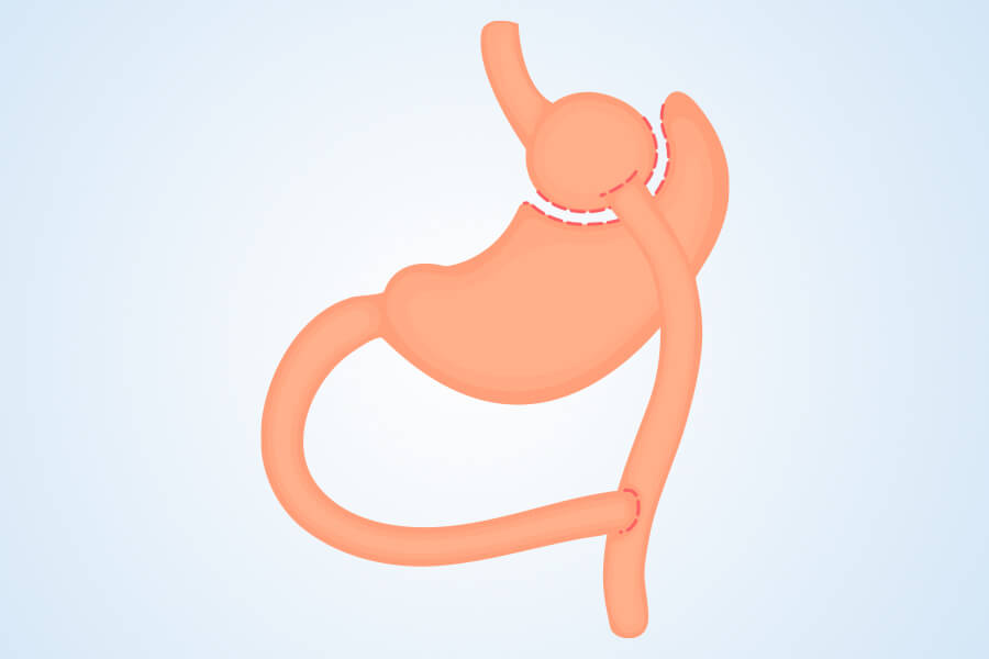 Gastric Sleeve in Turkey Gastric Sleeve in Turkey