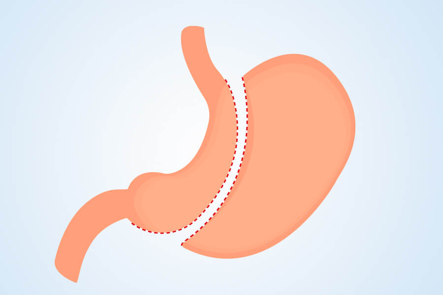 Gastric Sleeve in Turkey Gastric Sleeve in Turkey