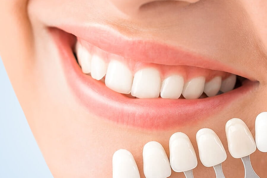 Laminate Veneers Cost in Turkey Laminate Veneers Cost in Turkey