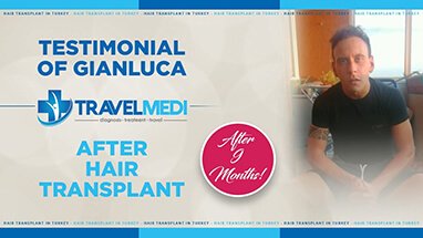 Review after 9 months hair transplant operation