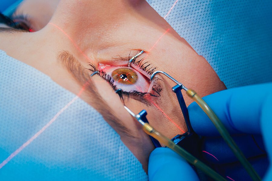 Femto LASIK Femto LASIK
