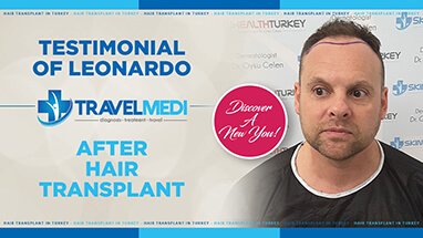 Review after 9 months hair transplant operation