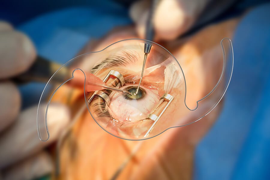 Multifocal Trifocal Lenses Multifocal Trifocal Lenses